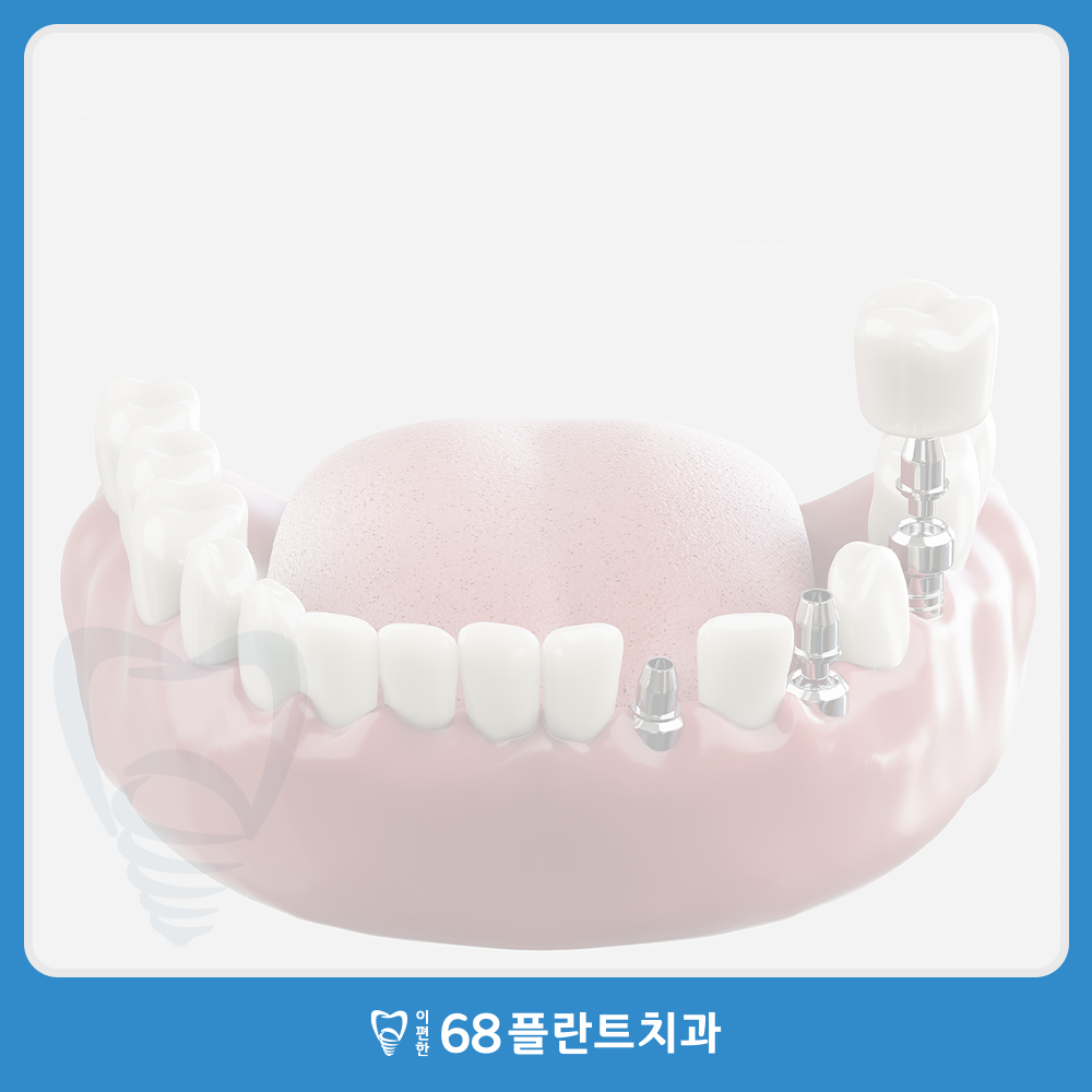 철산역임플란트