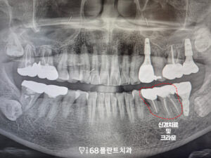 철산역임플란트
