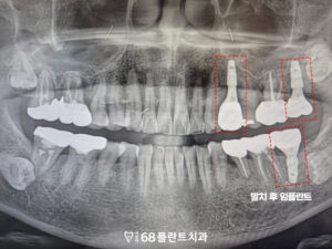 철산역임플란트