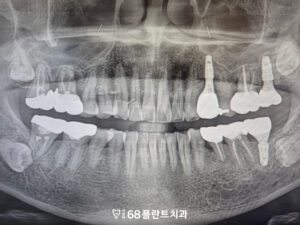 철산역임플란트