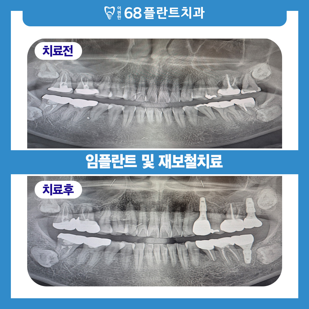 철산역임플란트