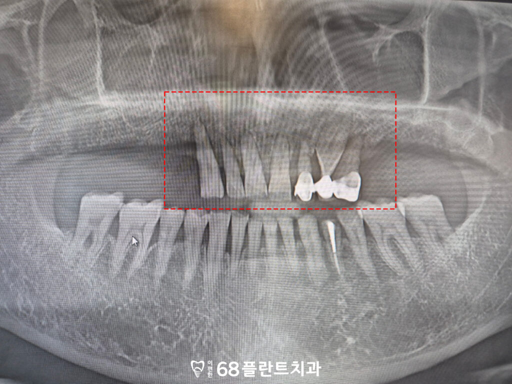 철산역임플란트