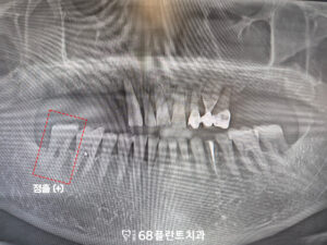 철산역임플란트