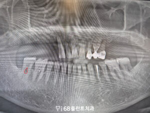 철산역임플란트