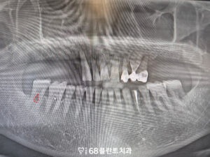 철산역임플란트