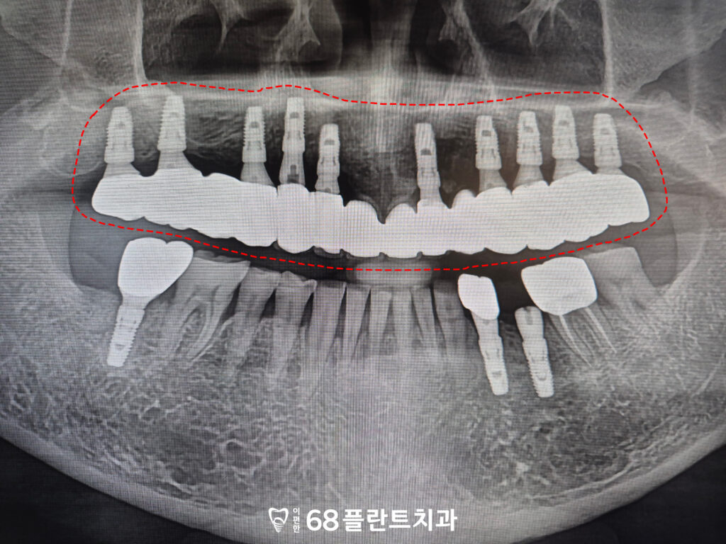 철산역임플란트