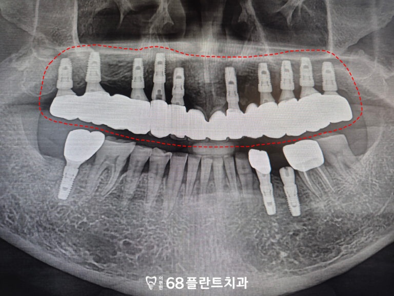 철산역임플란트