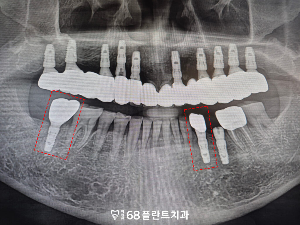 철산역임플란트