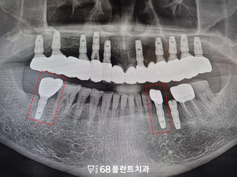 철산역임플란트