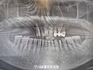 철산역임플란트