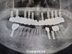 철산역임플란트