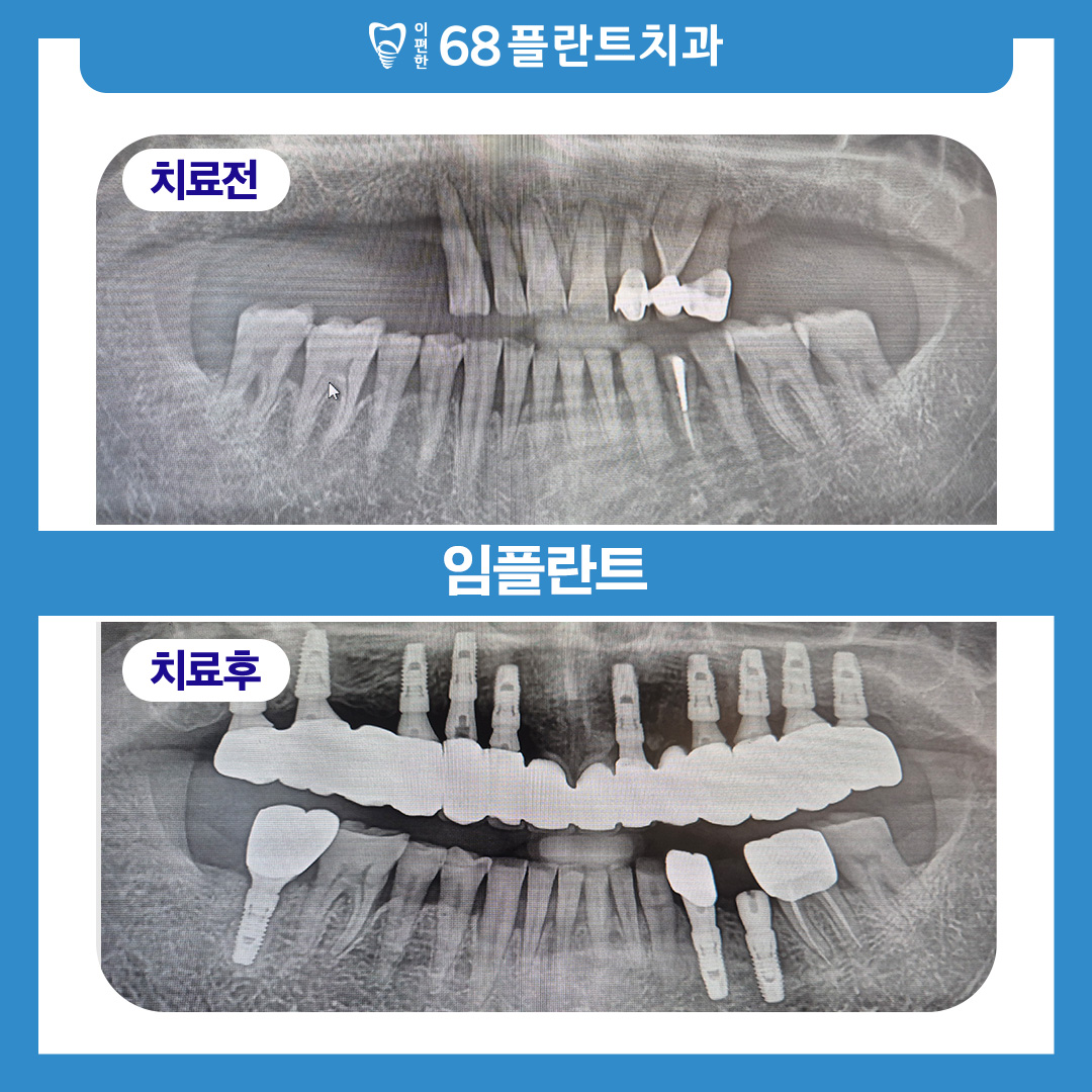 철산역임플란트